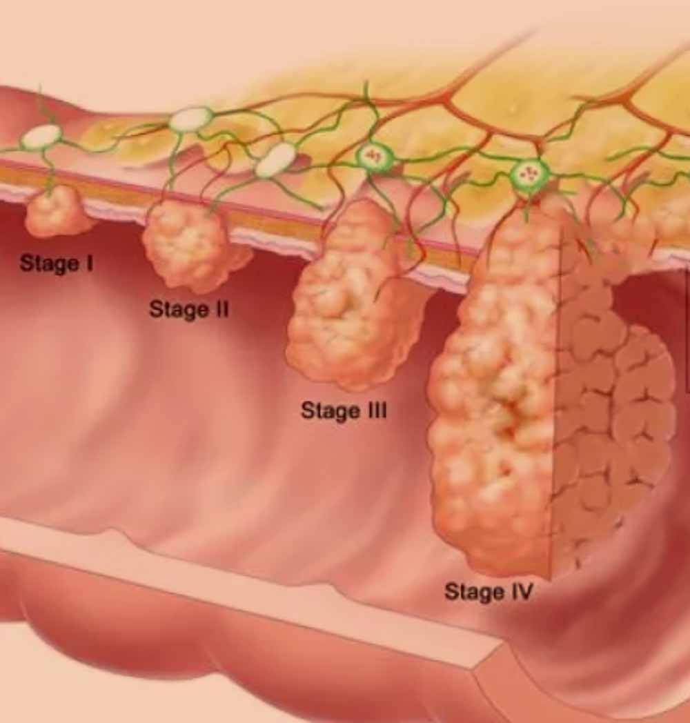 stopnje kolorektalnega raka